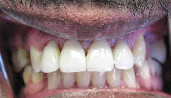 After image